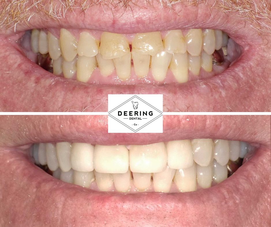 Biomimetic Dentist Miami Deering Dental in Palmetto Bay, near Pinecrest Biomimetic Dentist Miami Deering Dental in Palmetto Bay, near Pinecrest