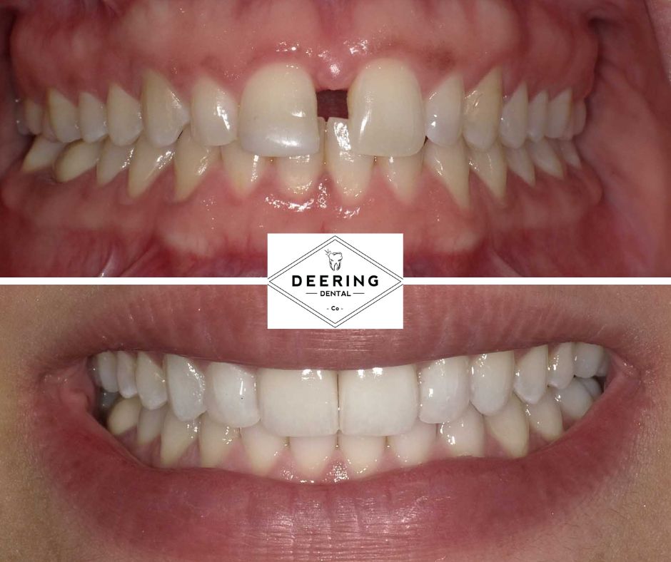 Biomimetic Dentist Miami Deering Dental in Palmetto Bay, near Pinecrest Biomimetic Dentist Miami Deering Dental in Palmetto Bay, near Pinecrest