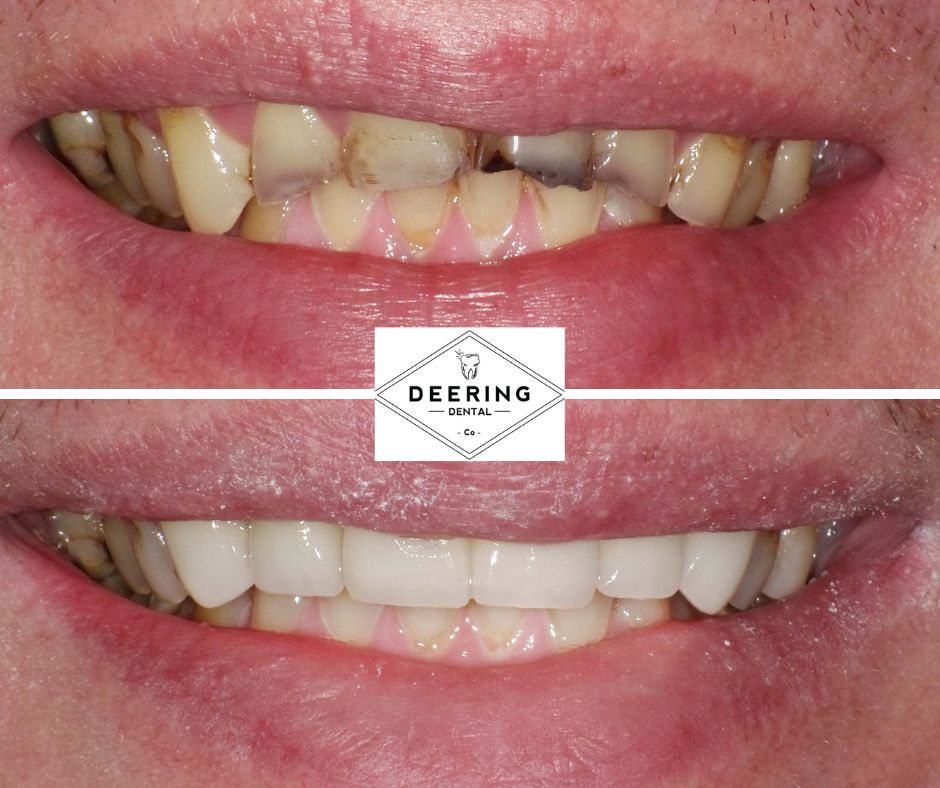 Biomimetic Dentist Miami Deering Dental in Palmetto Bay, near Pinecrest Biomimetic Dentist Miami Deering Dental in Palmetto Bay, near Pinecrest