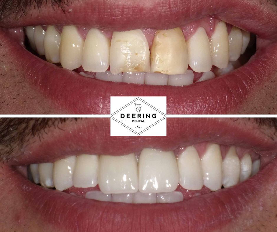 Biomimetic Dentist Miami Deering Dental in Palmetto Bay, near Pinecrest Biomimetic Dentist Miami Deering Dental in Palmetto Bay, near Pinecrest