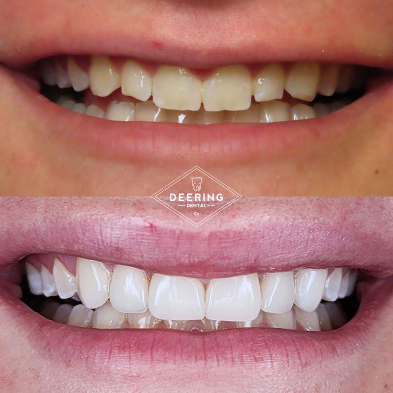 Best Cosmetic Dentist Miami Deering Dental in Palmetto Bay, near Pinecrest before and afters of the veneers treatment