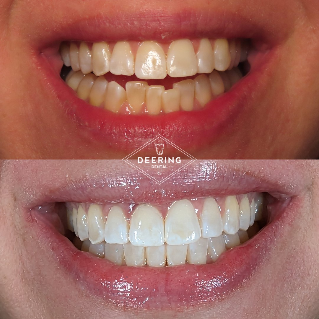 Best Cosmetic Dentist Miami Deering Dental in Palmetto Bay, near Pinecrest Best Cosmetic Dentist Miami Deering Dental in Palmetto Bay, near Pinecrest