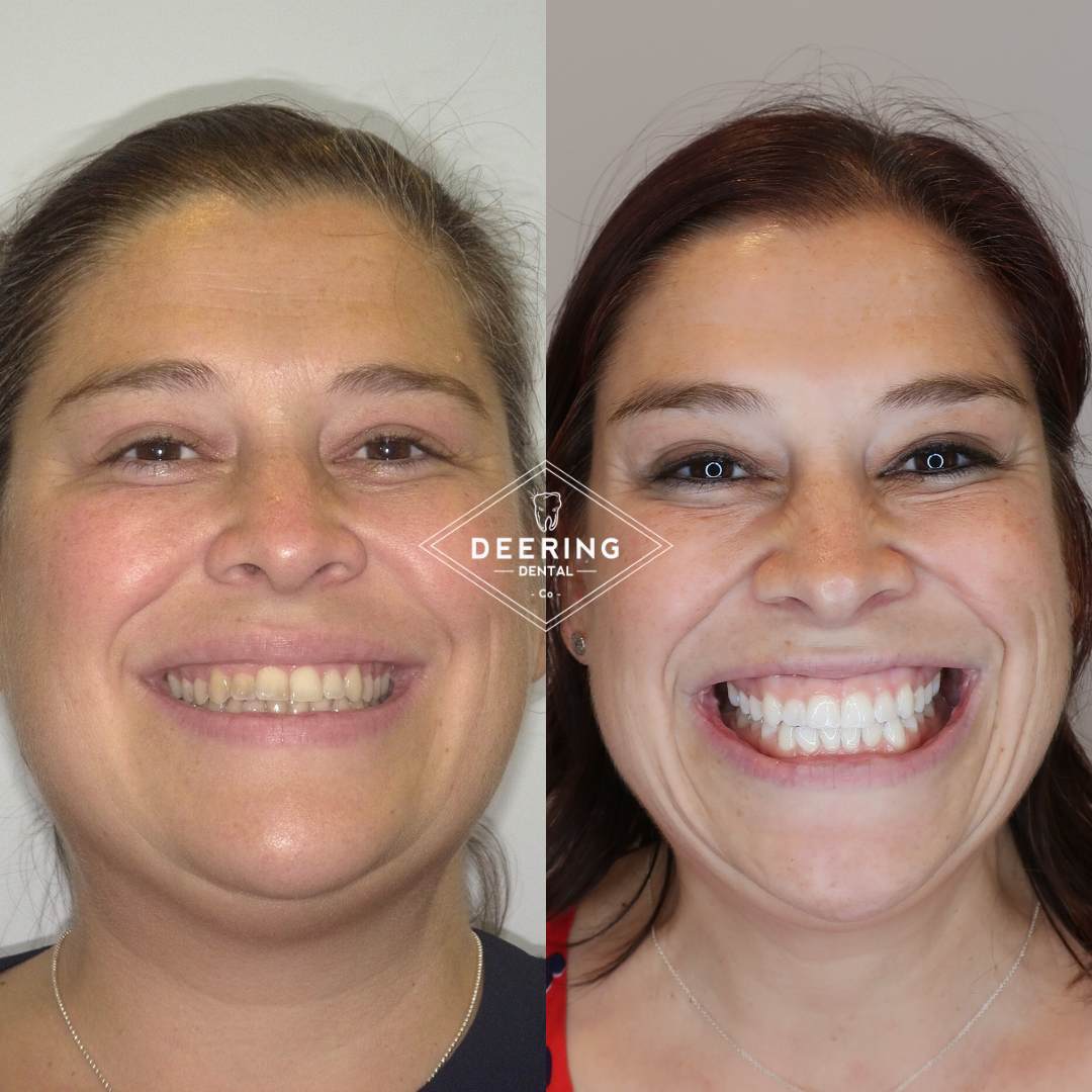 Deering Dental, Functional & Biomimetic Dentist Miami Deering Dental in Palmetto Bay, near Pinecrest Cosmetic treatment in Miami at Deering Dental
