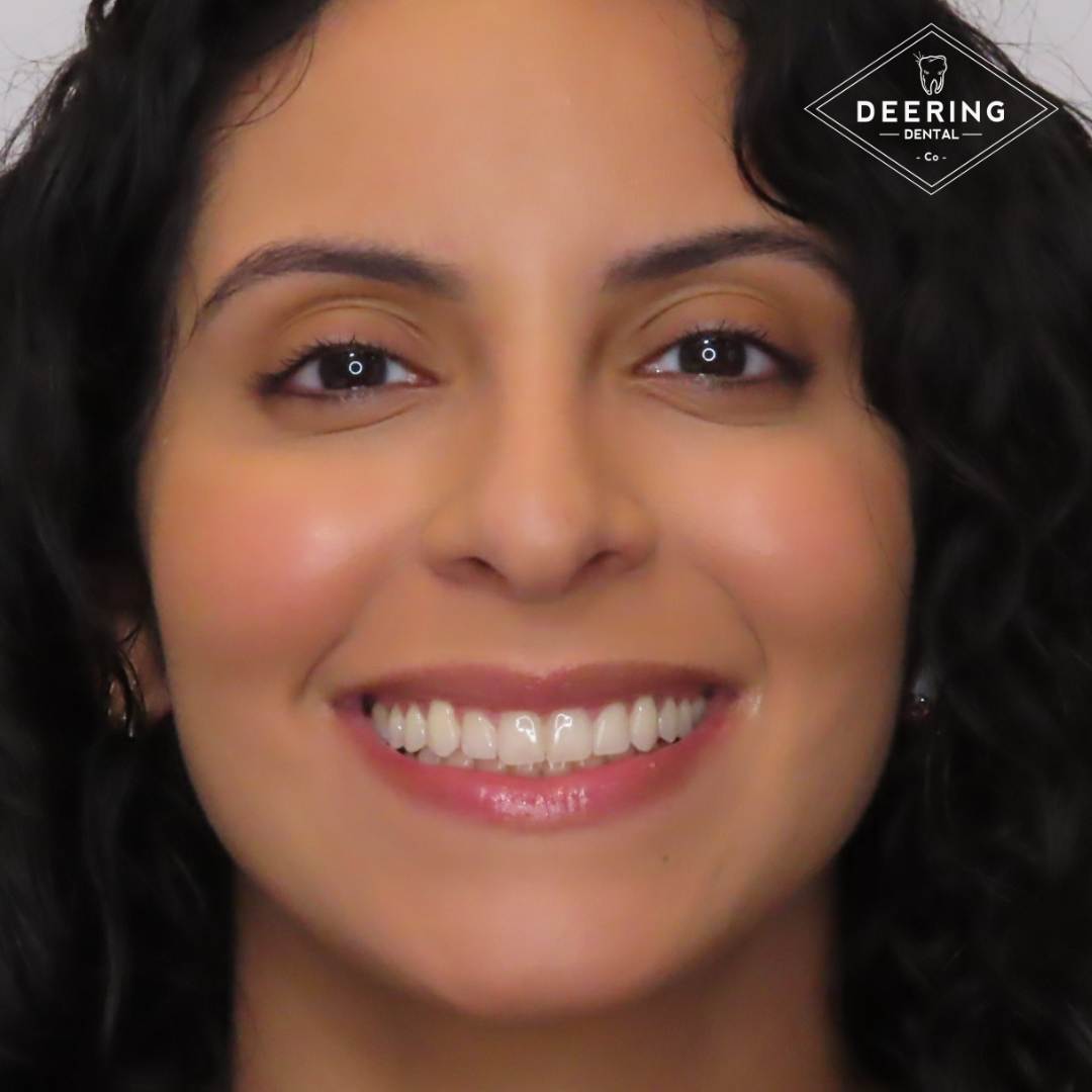 Teeth Whitening Deering Dental in Palmetto Bay, near Pinecrest Teeth whitening results Miami