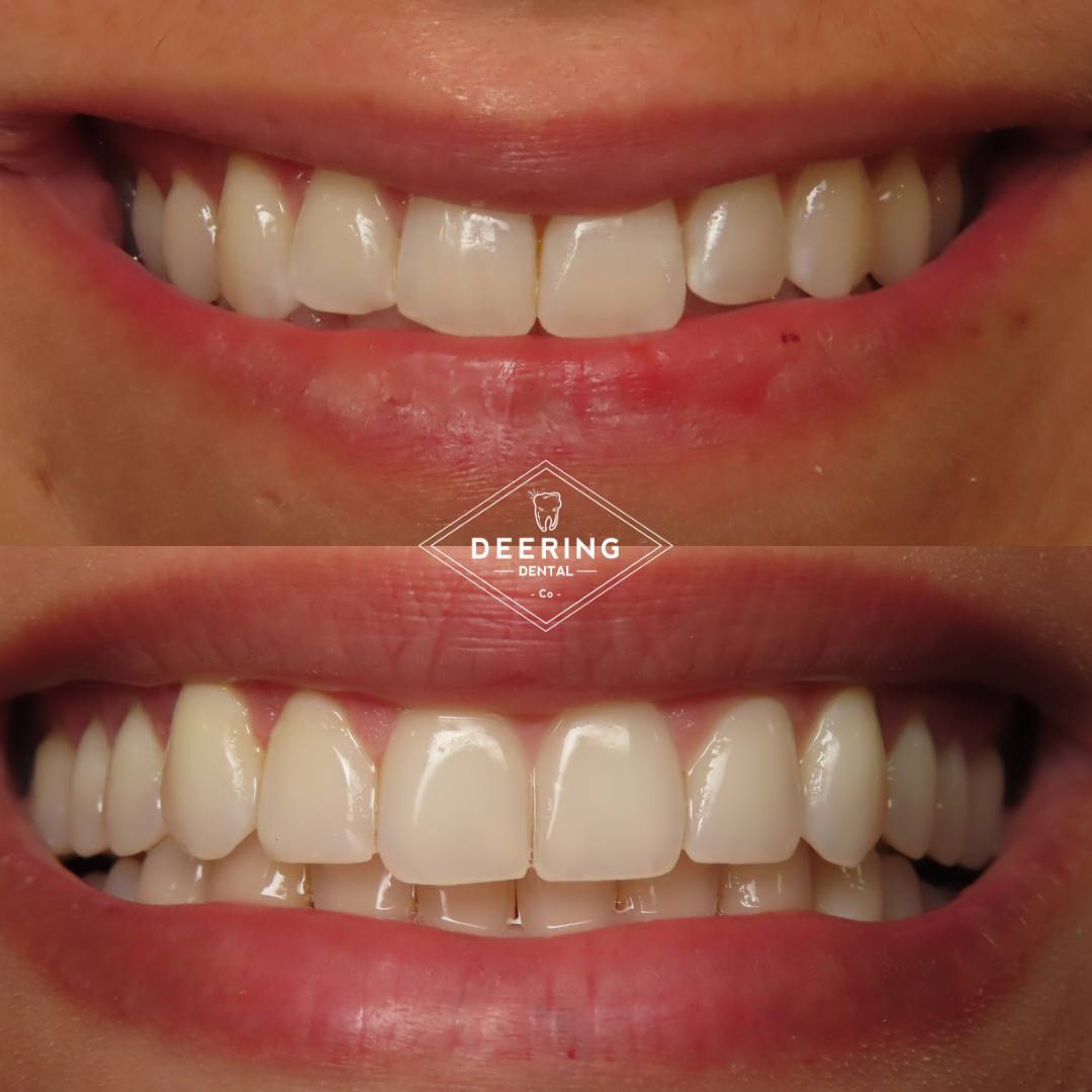 Teeth Whitening Deering Dental in Palmetto Bay, near Pinecrest Teeth whitening results Miami