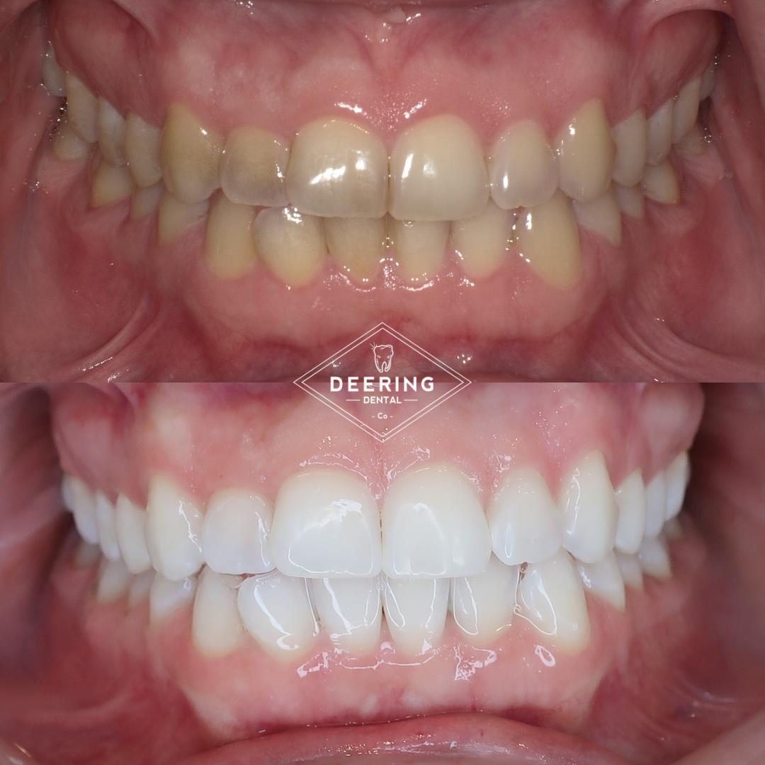 Deering Dental, Functional & Biomimetic Dentist Miami Deering Dental in Palmetto Bay, near Pinecrest Cosmetic treatment in Miami at Deering Dental