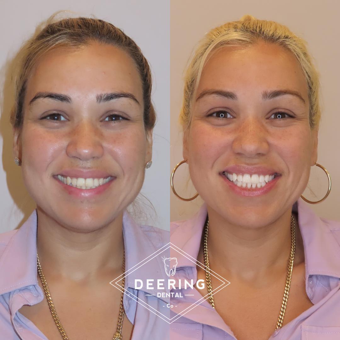 Deering Dental, Functional & Biomimetic Dentist Miami Deering Dental in Palmetto Bay, near Pinecrest Cosmetic treatment in Miami at Deering Dental
