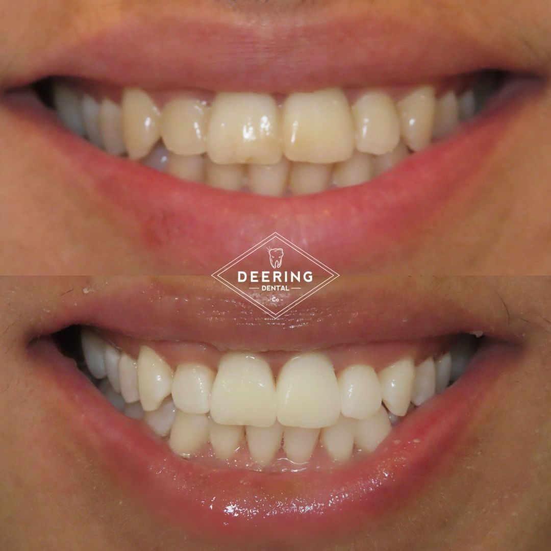 Deering Dental, Functional & Biomimetic Dentist Miami Deering Dental in Palmetto Bay, near Pinecrest Cosmetic treatment in Miami at Deering Dental