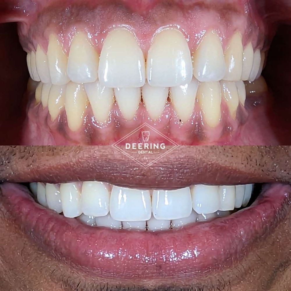Invisalign Dentist Palmetto Bay Deering Dental in Palmetto Bay, near Pinecrest Before & After Invisalign Treatment