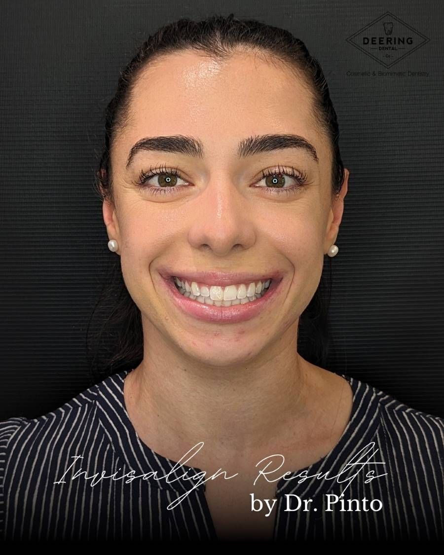 Invisalign Dentist Palmetto Bay Deering Dental in Palmetto Bay, near Pinecrest After Invisalign Treatment