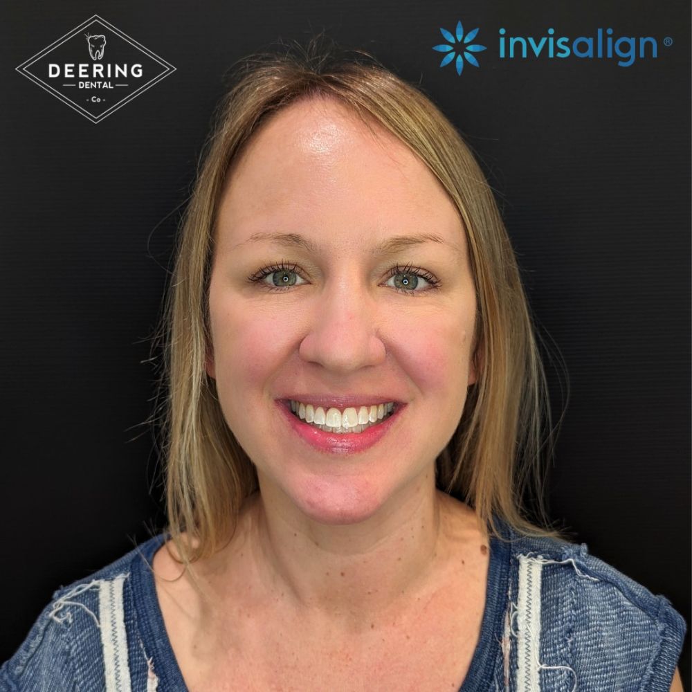 Invisalign Dentist Palmetto Bay Deering Dental in Palmetto Bay, near Pinecrest After Invisalign Treatment
