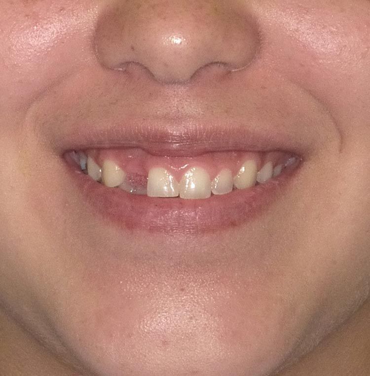 Recover Smile With Deering Dental Implants Deering Dental in Palmetto Bay, near Pinecrest Before Dental Implant Treatment